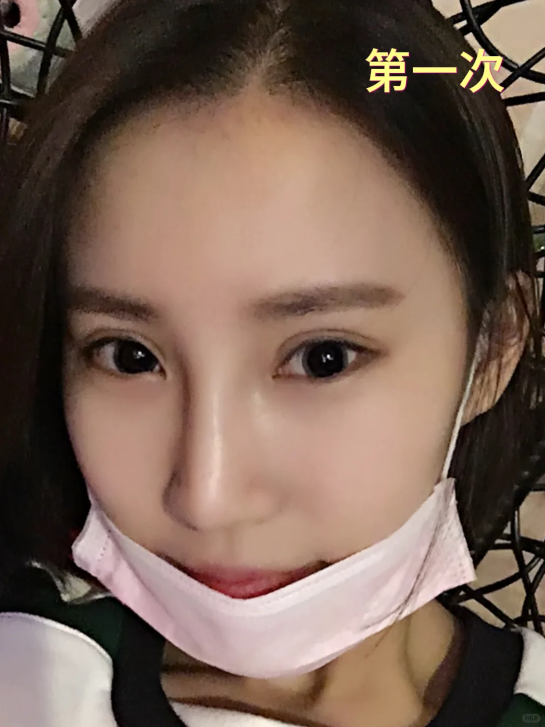 整形15年，我竟成了鼻修复“专业户”