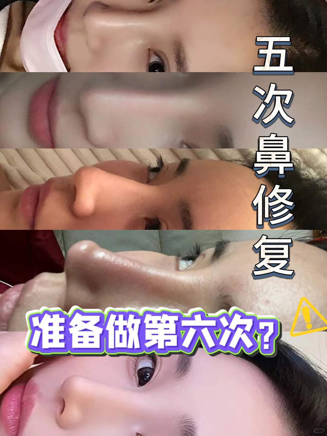 整形15年，我竟成了鼻修复“专业户”