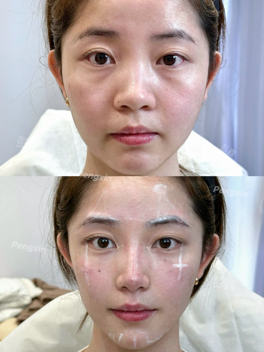 扁平脸＋垮脸凹陷，在上海全脸用了4只，变化也