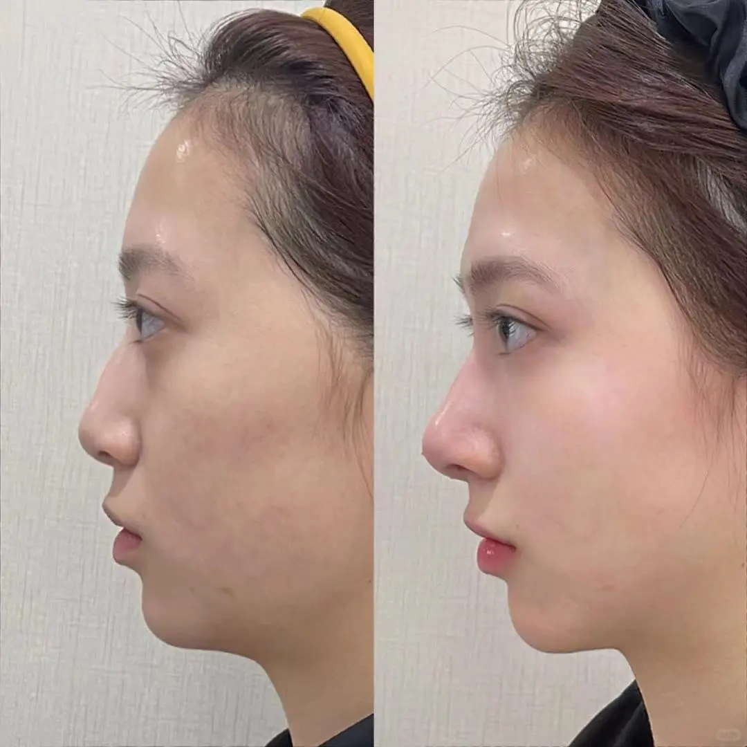 没有对比就没有伤害,妈生鼻V再生鼻