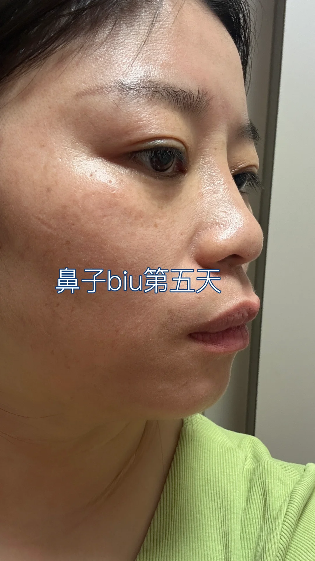 鼻子biu 的第五天