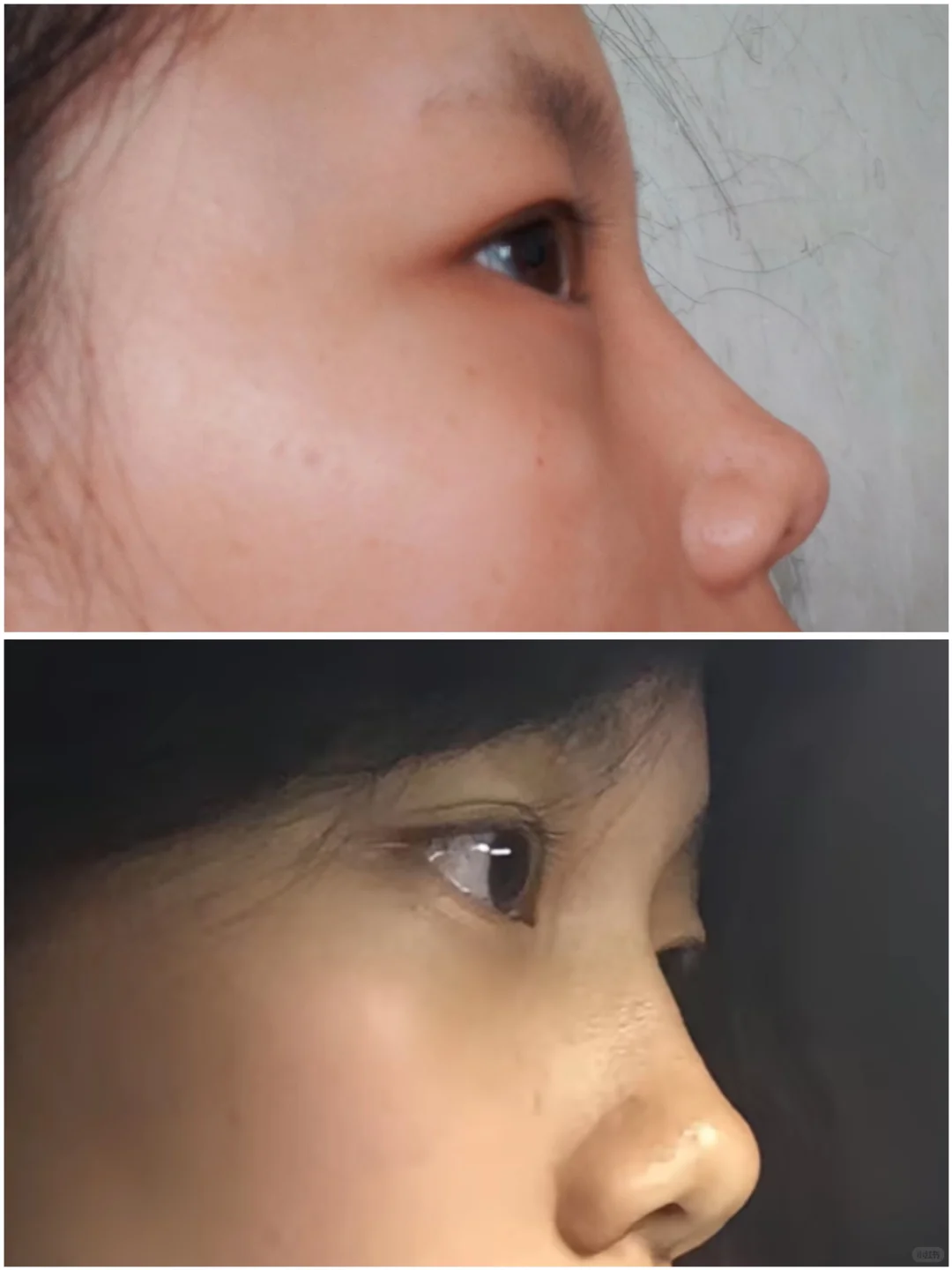 后悔！为什么没早点do菲欧曼致塑隆鼻