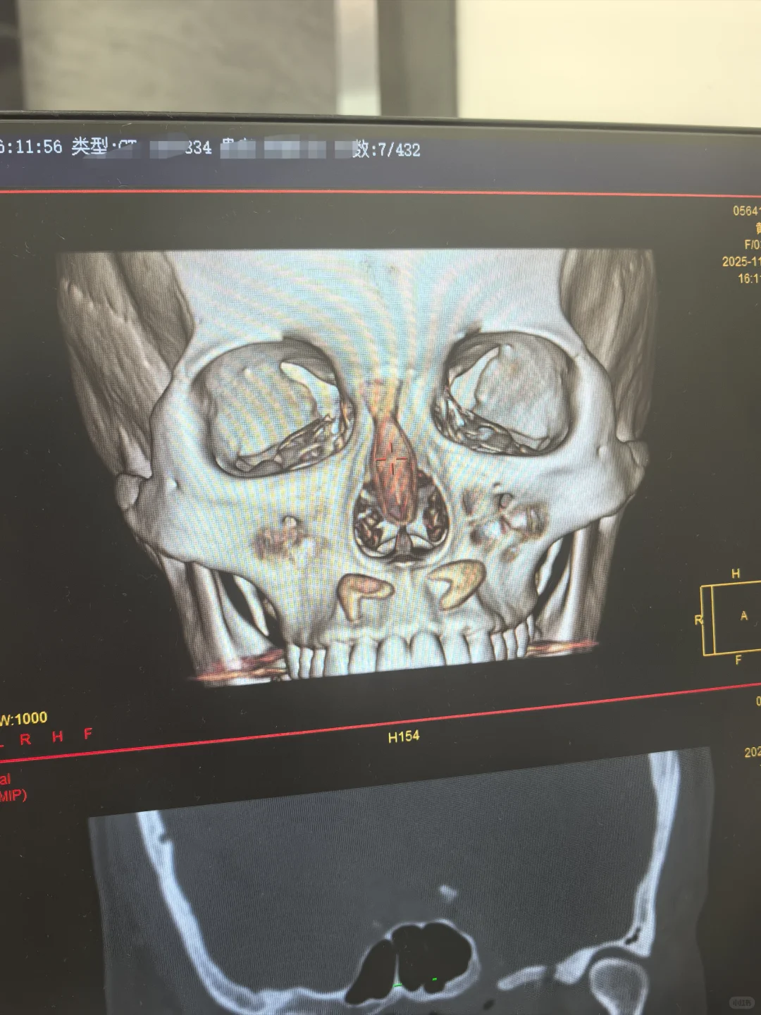 想到就生气，隆鼻