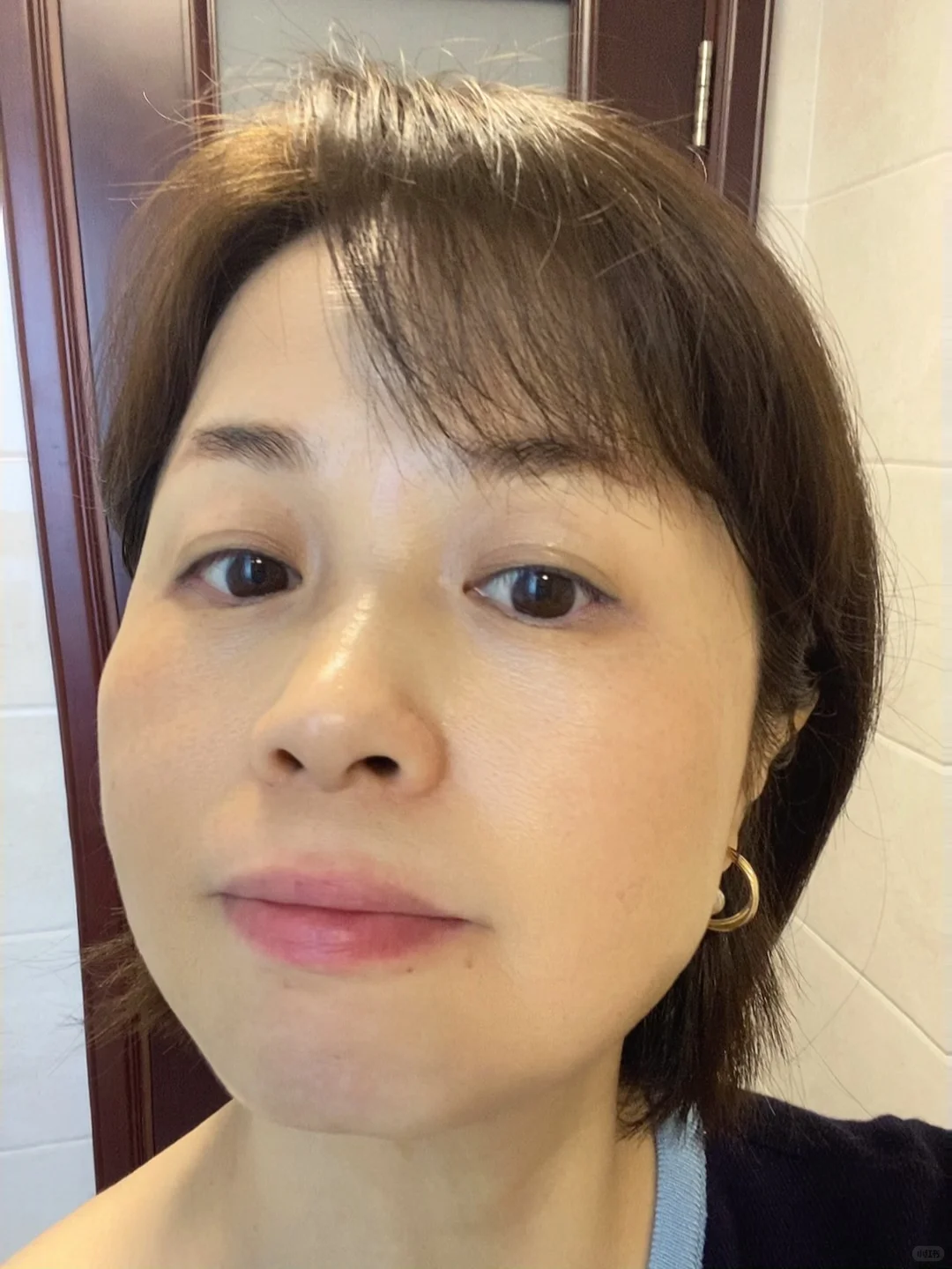 炎症排出来了！我真的没整容！