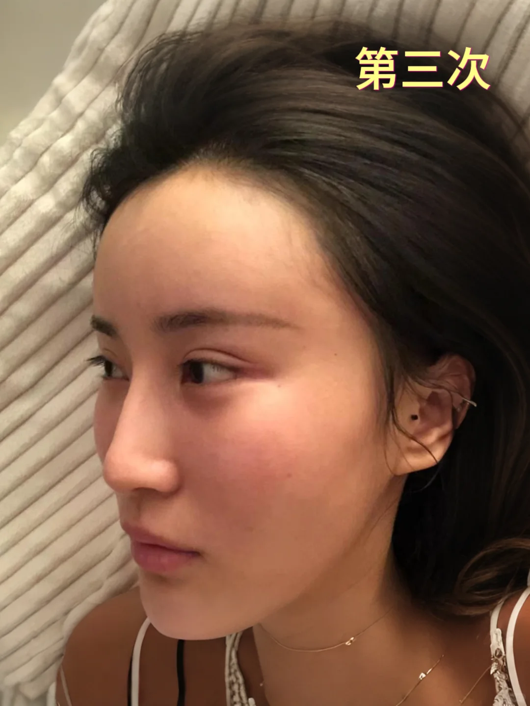 整形15年，我竟成了鼻修复“专业户”