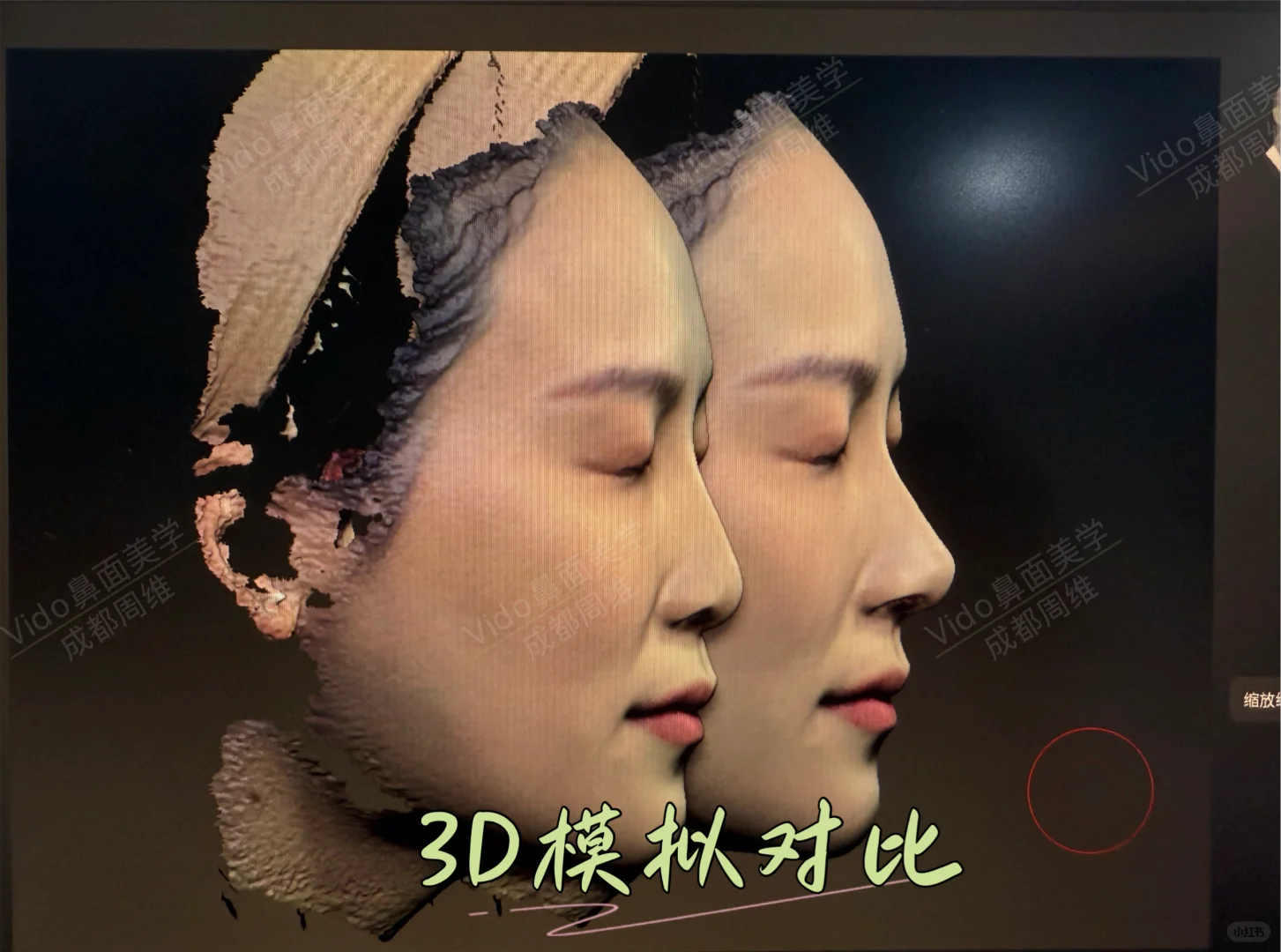直鼻微翘，3D模拟对比