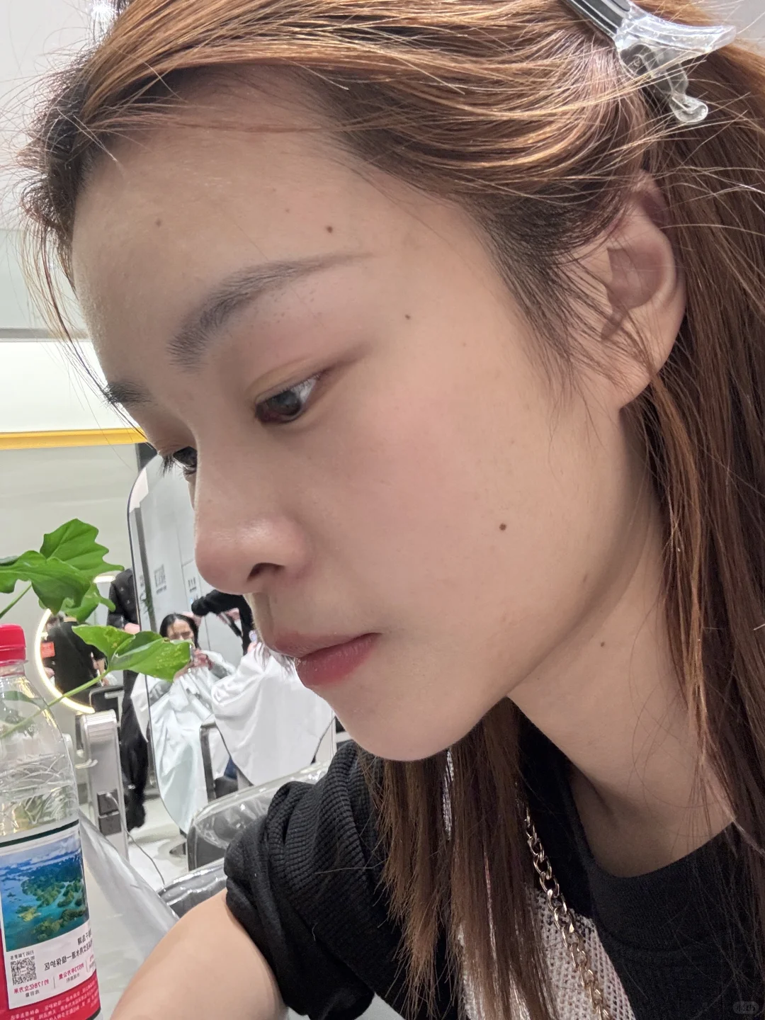 求助：隆鼻哪一种疤痕可以不明显