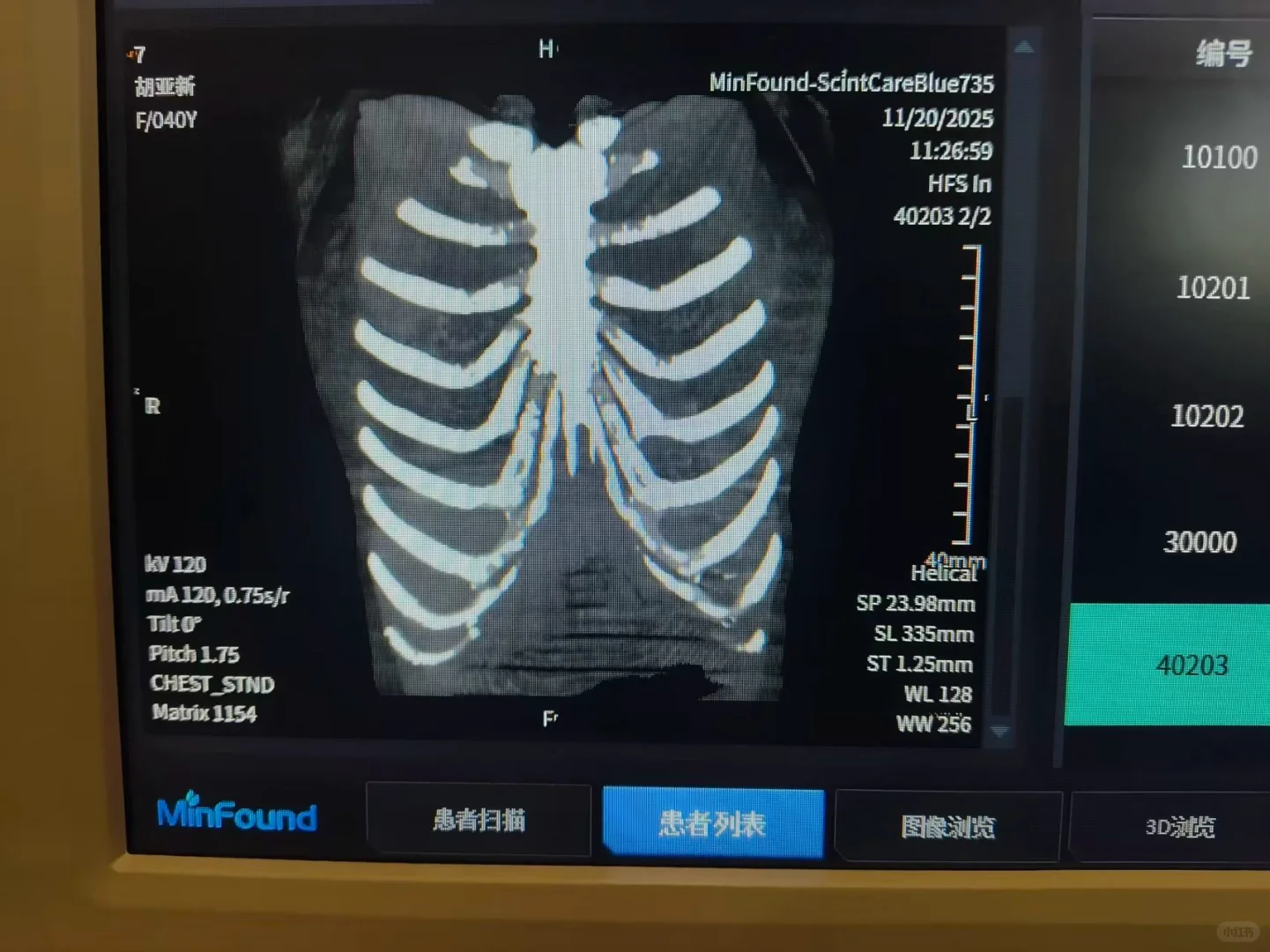 钙化这个程度还可以做肋骨鼻吗