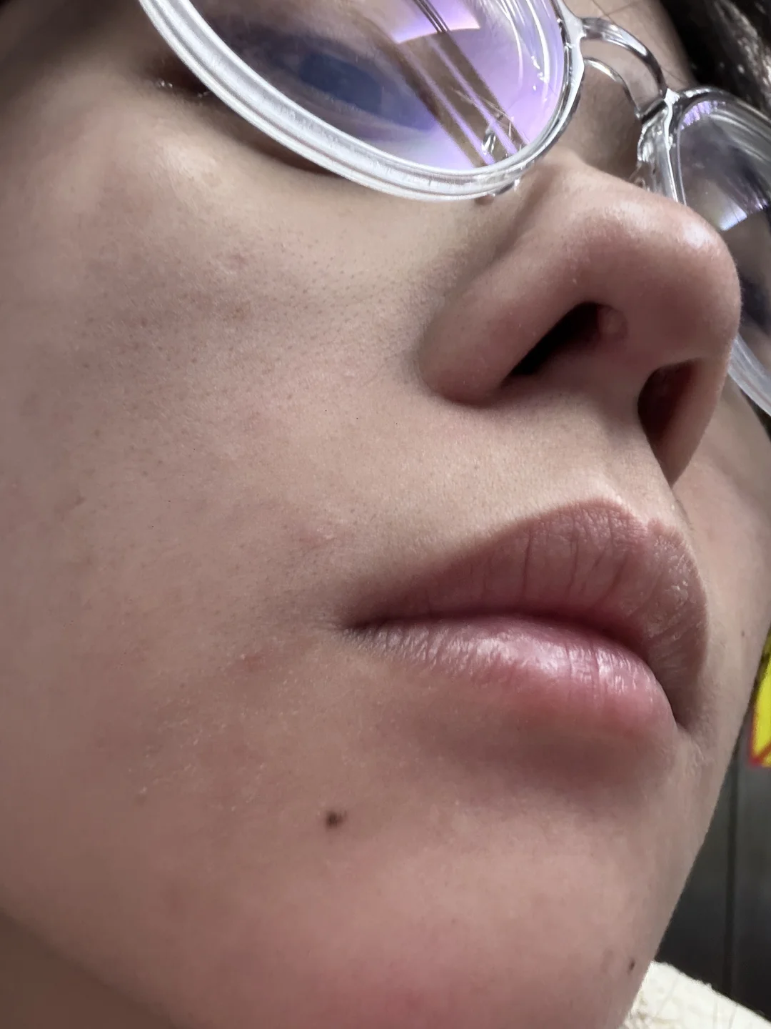 隆鼻后这是什么