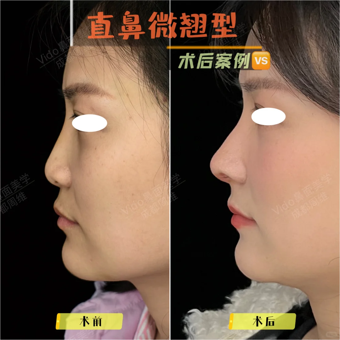 直鼻微翘，3D模拟对比