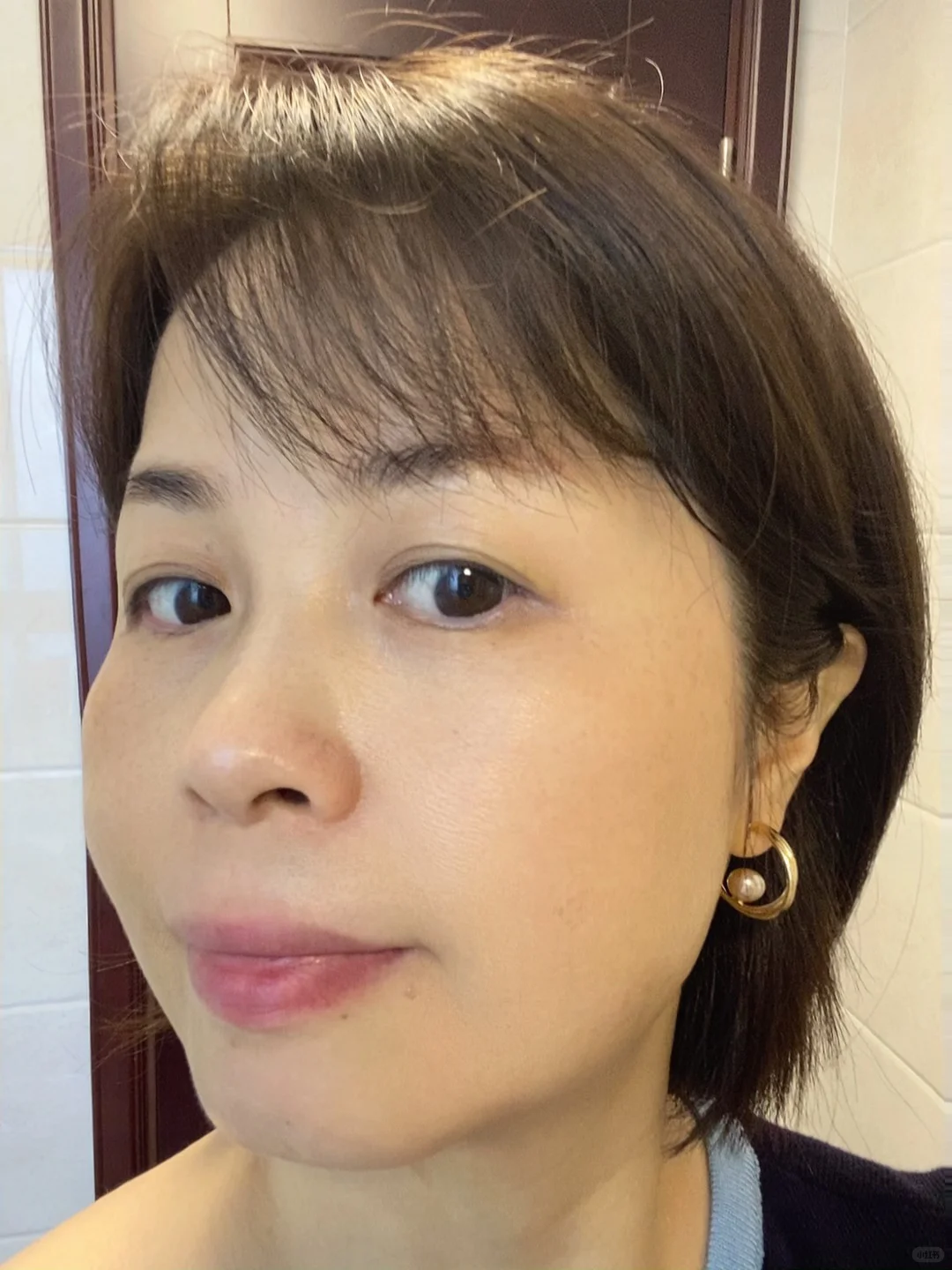 炎症排出来了！我真的没整容！