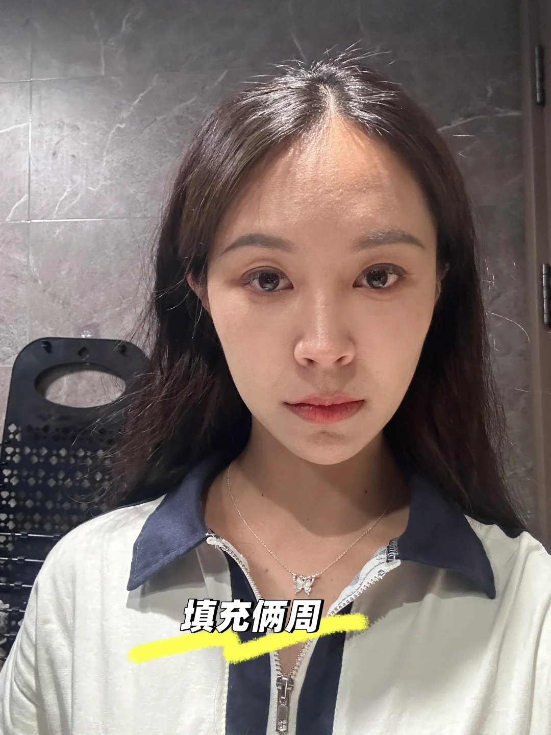 脂肪填充面部半个月