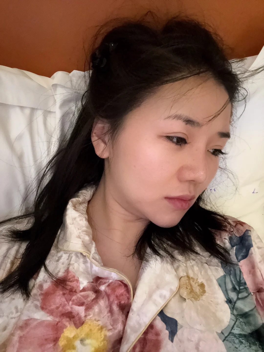 来长沙做鼻子了 手术完成后续