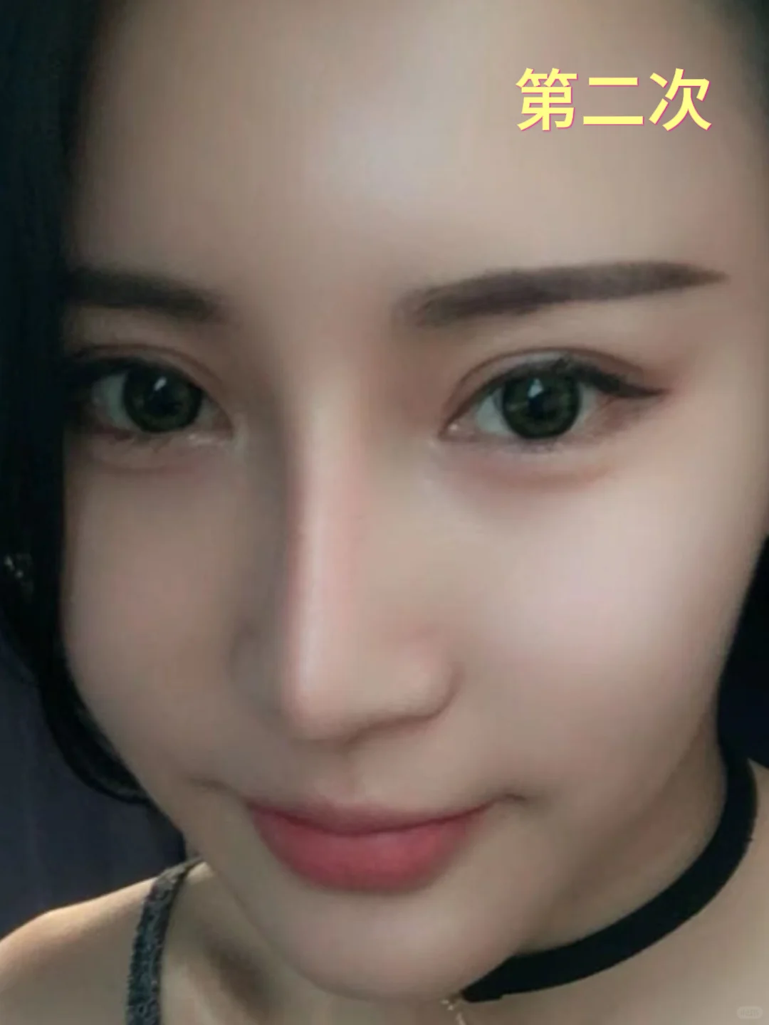 整形15年，我竟成了鼻修复“专业户”