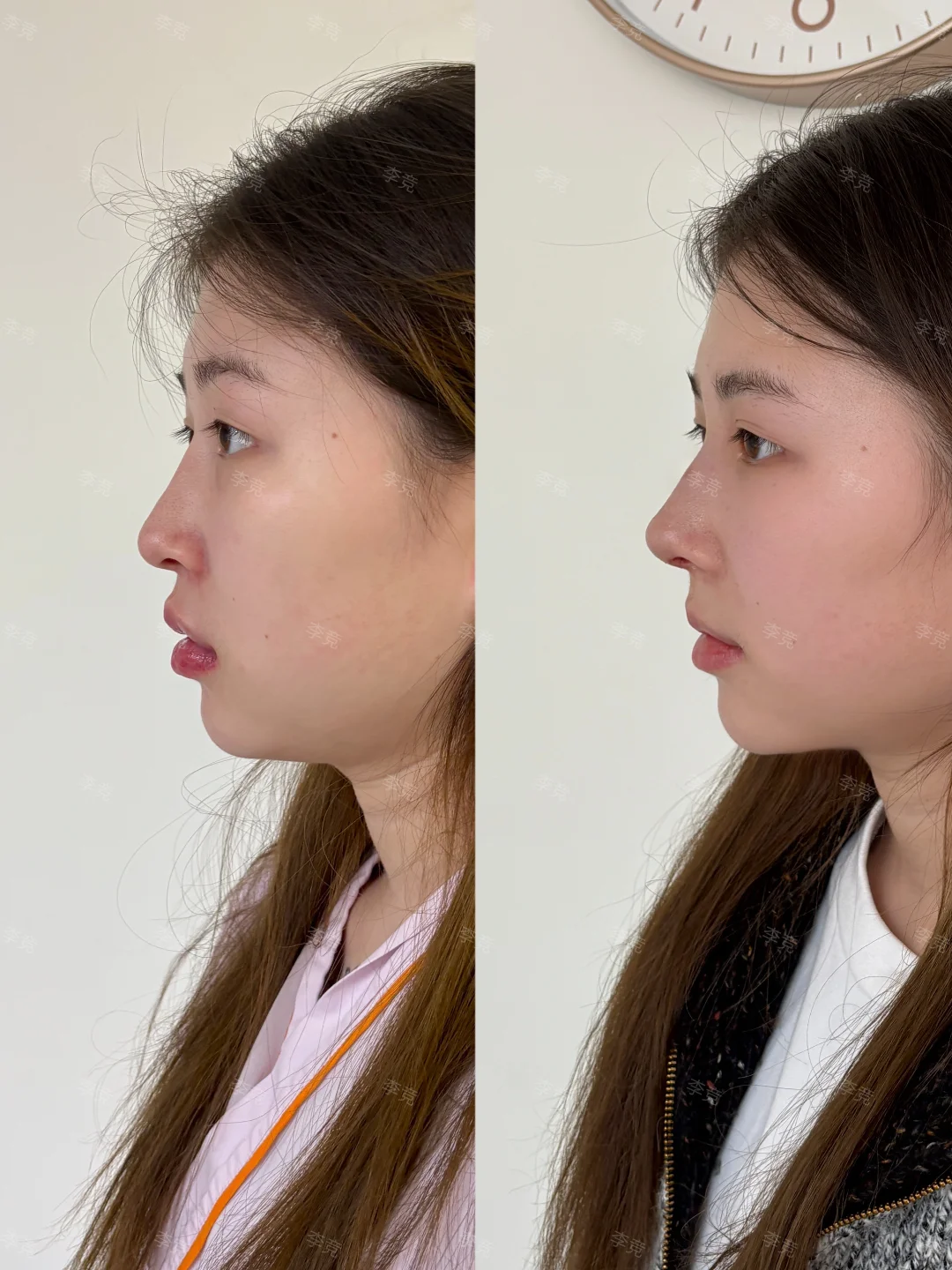 成都隆鼻圣手|纤铂塑造上镜骨感鼻