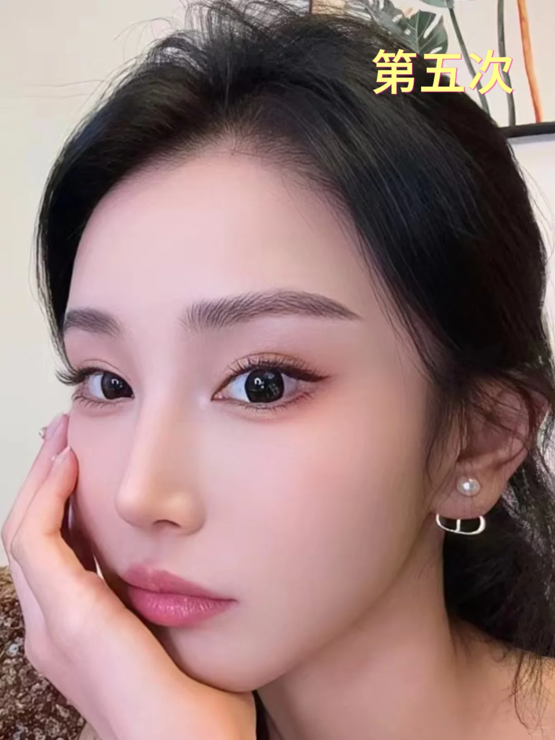 整形15年，我竟成了鼻修复“专业户”