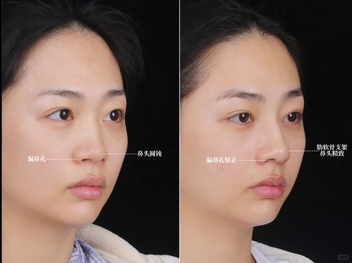 深圳do鼻|宽鼻+鼻基底凹陷