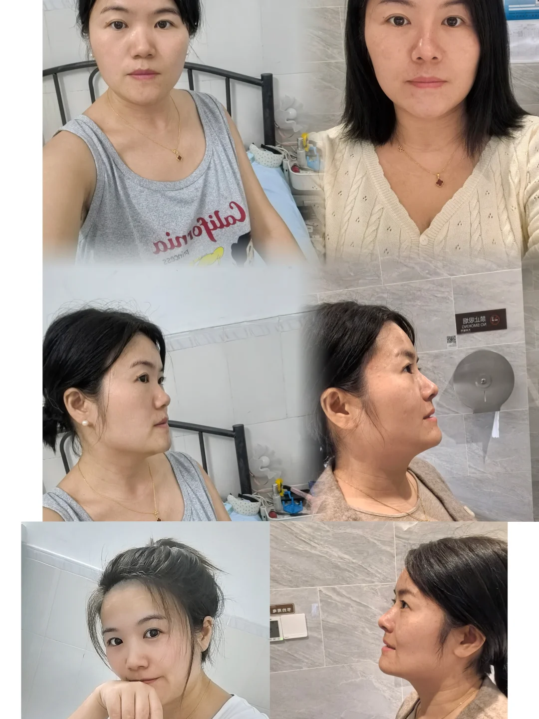 隆鼻原本甜妹系，现在显男相？