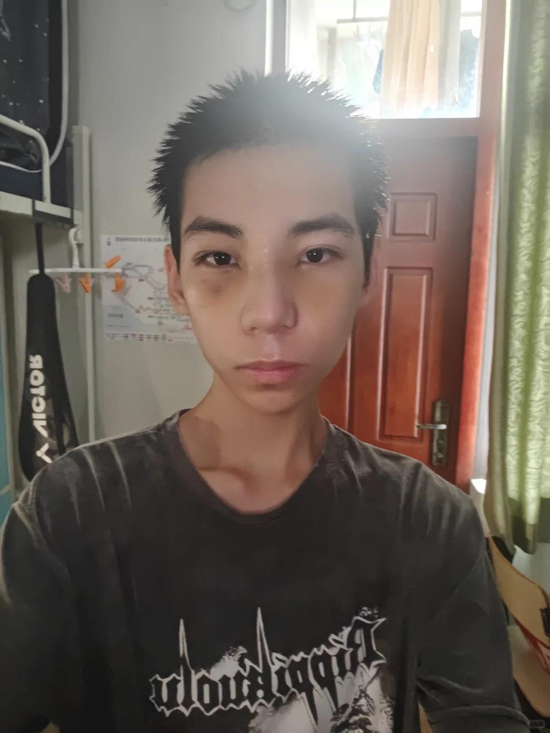 蹲的来看!do鼻9天脸和鼻子都消肿了很多啦