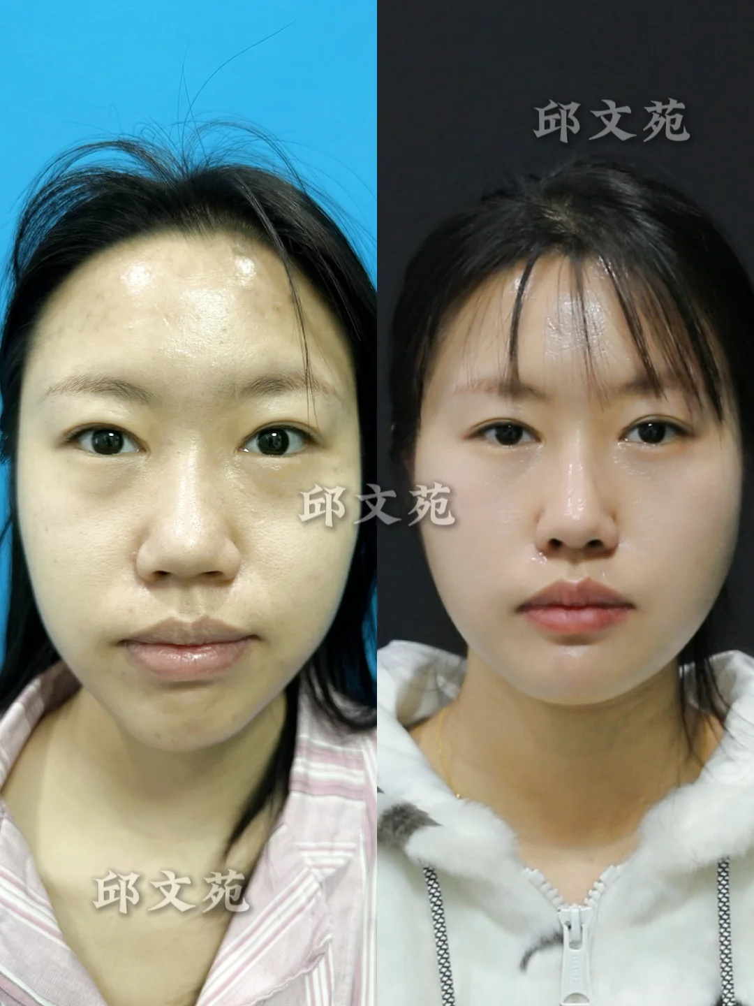 大鼻头修复丨妈生感直鼻微翘