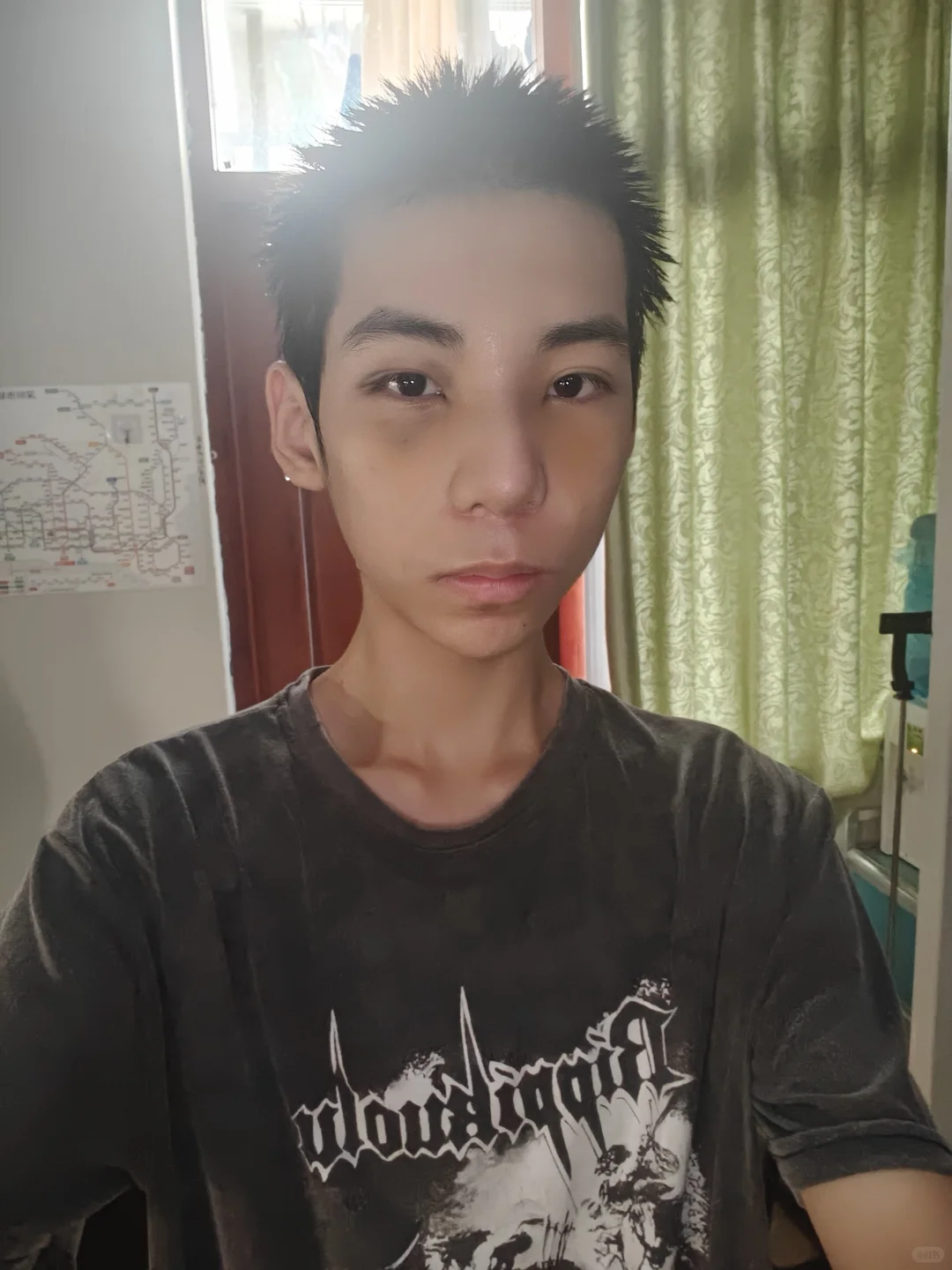 蹲的来看!do鼻9天脸和鼻子都消肿了很多啦