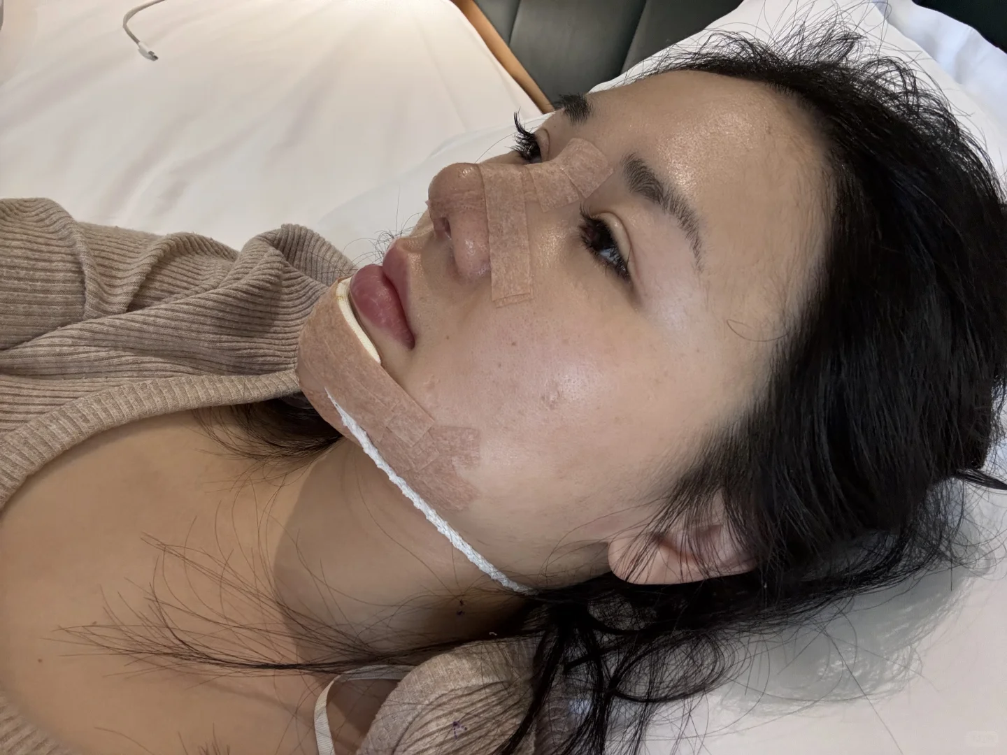 来长沙做鼻子了 手术完成后续