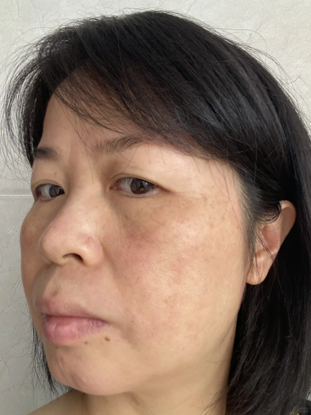 炎症排出来了！我真的没整容！