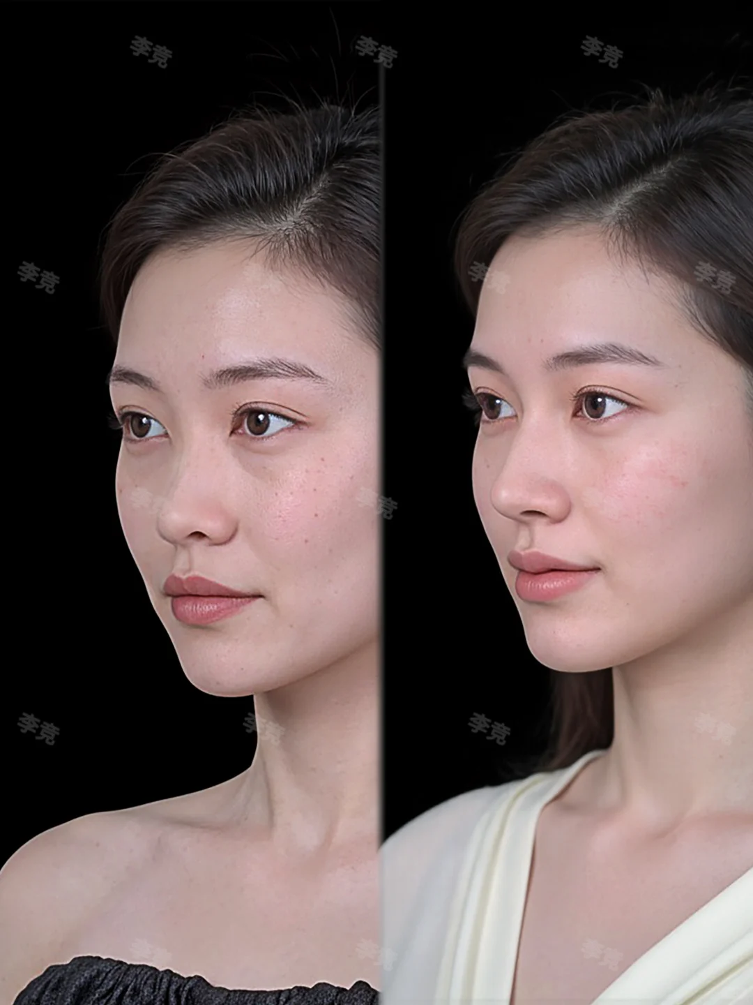 成都隆鼻|4mm抬高鼻背，微起伏精致骨感