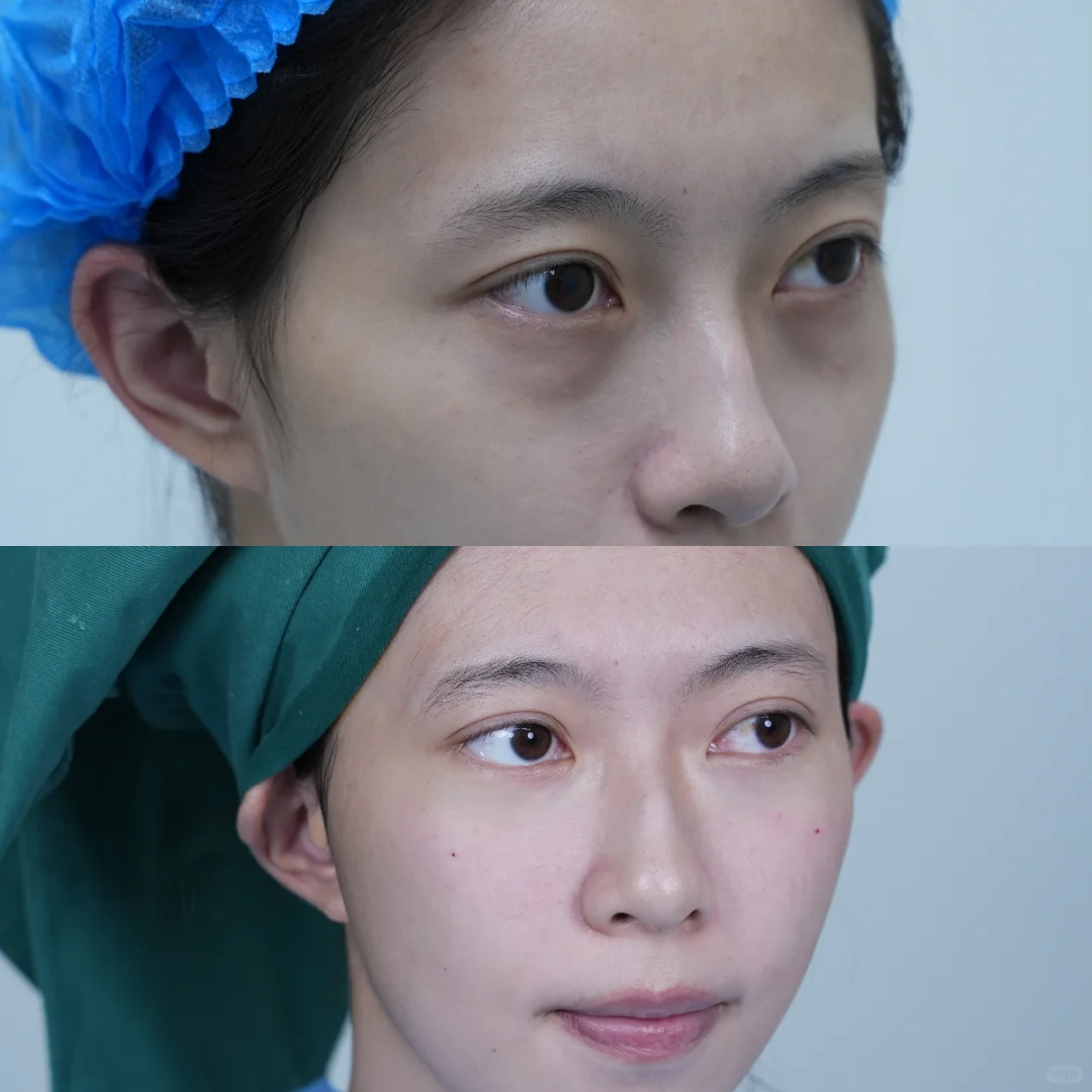 嘎完眼袋后就像变了一个人