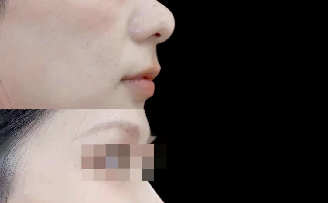 重塑鼻型美感，山根高度增加 2.3mm