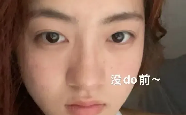 广州鼻子｜3个月现状