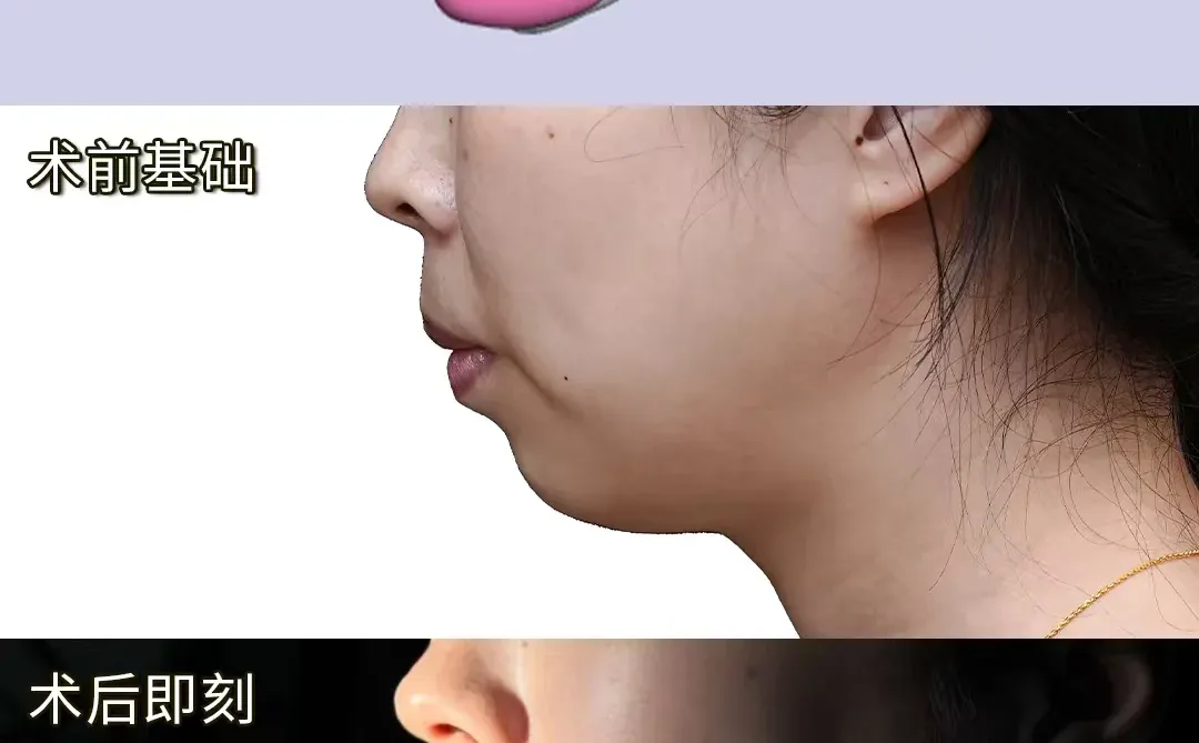 真的真的真的只是做了个下巴！