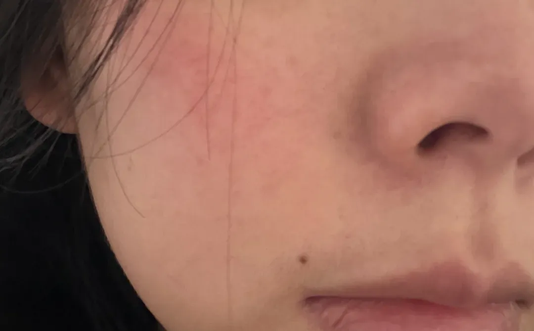 做完燃料第二天右边脸微微肿了