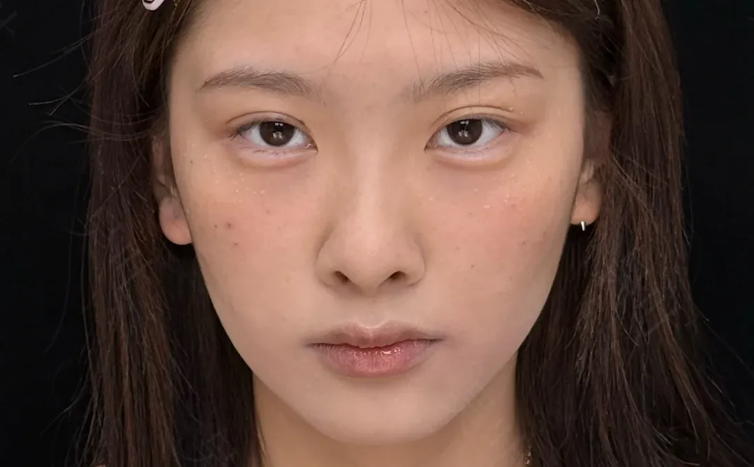 成都黑眼圈泪沟填充，live直出