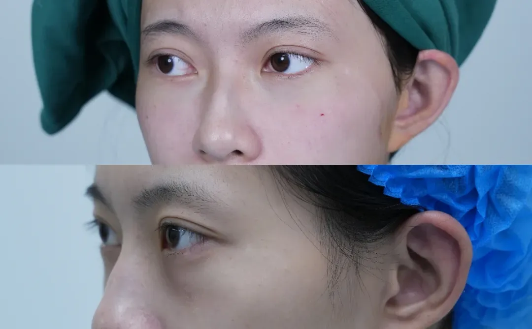 嘎完眼袋后就像变了一个人