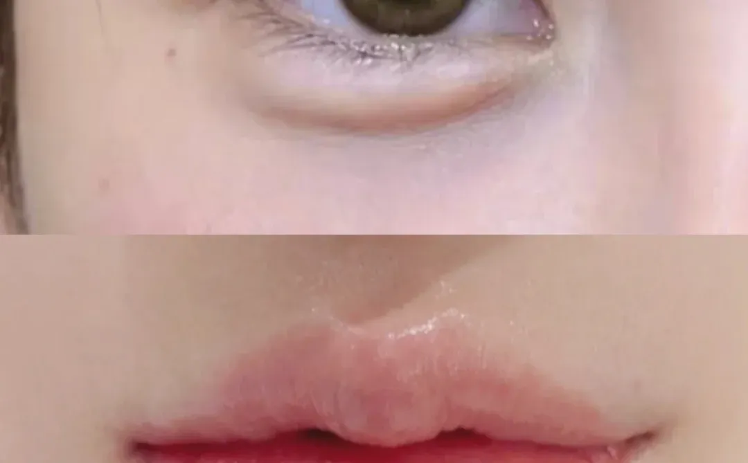 只用了1ml的卧蚕➕️丰唇