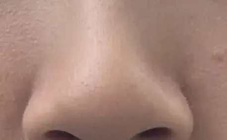 做了鼻翼鼻头缝合没放东西