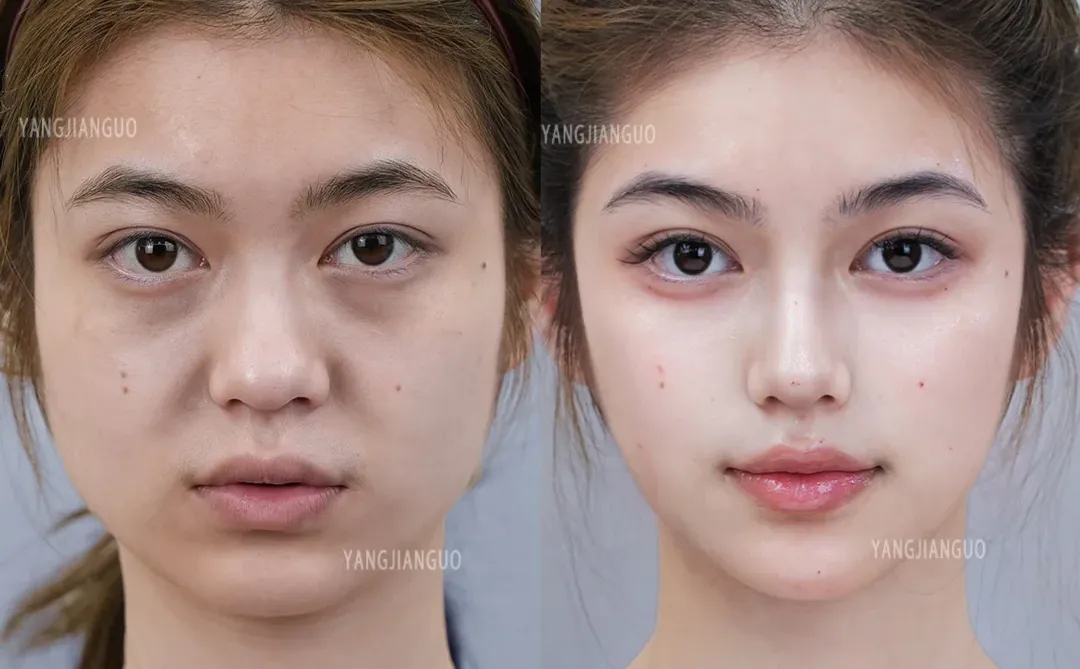 2支濡白鼻+鼻基底+下巴，微调完像换了一张脸