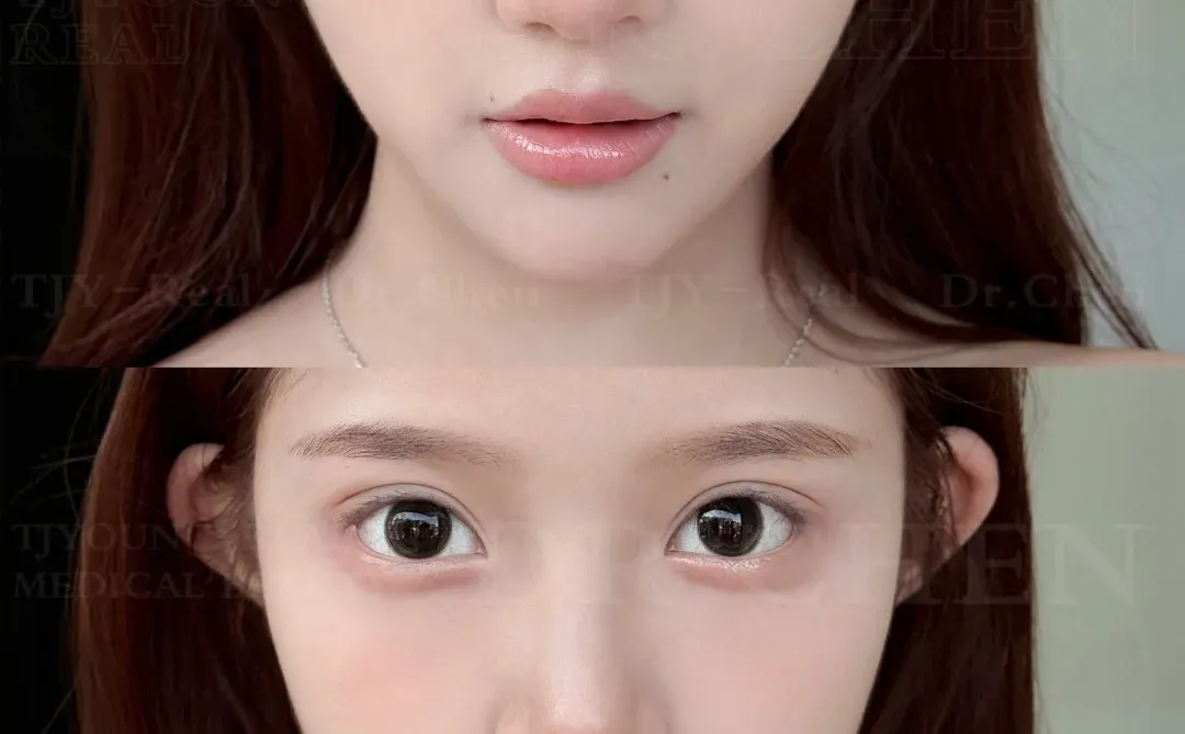 漫画款双眼皮｜7.8mm素颜也美❕