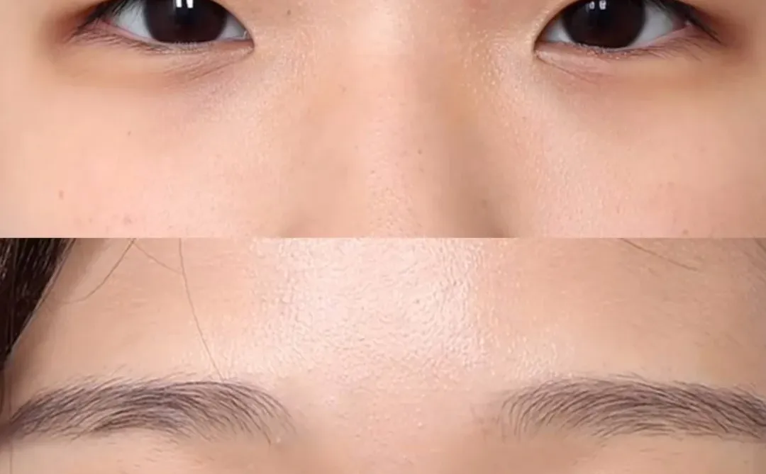 全切+开眼角-北京双眼皮展示