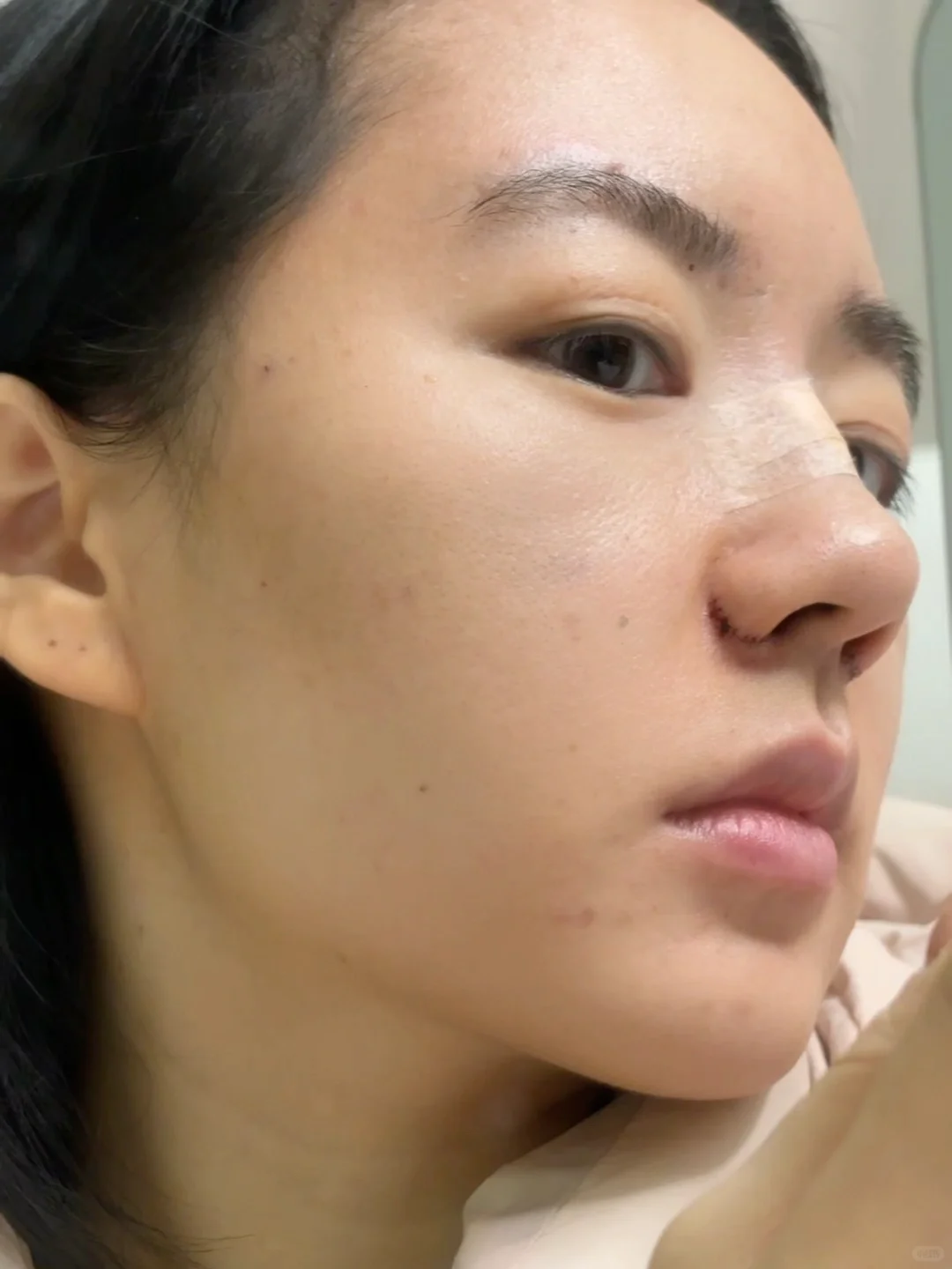 左划缩鼻翼+山根（双C）第10天