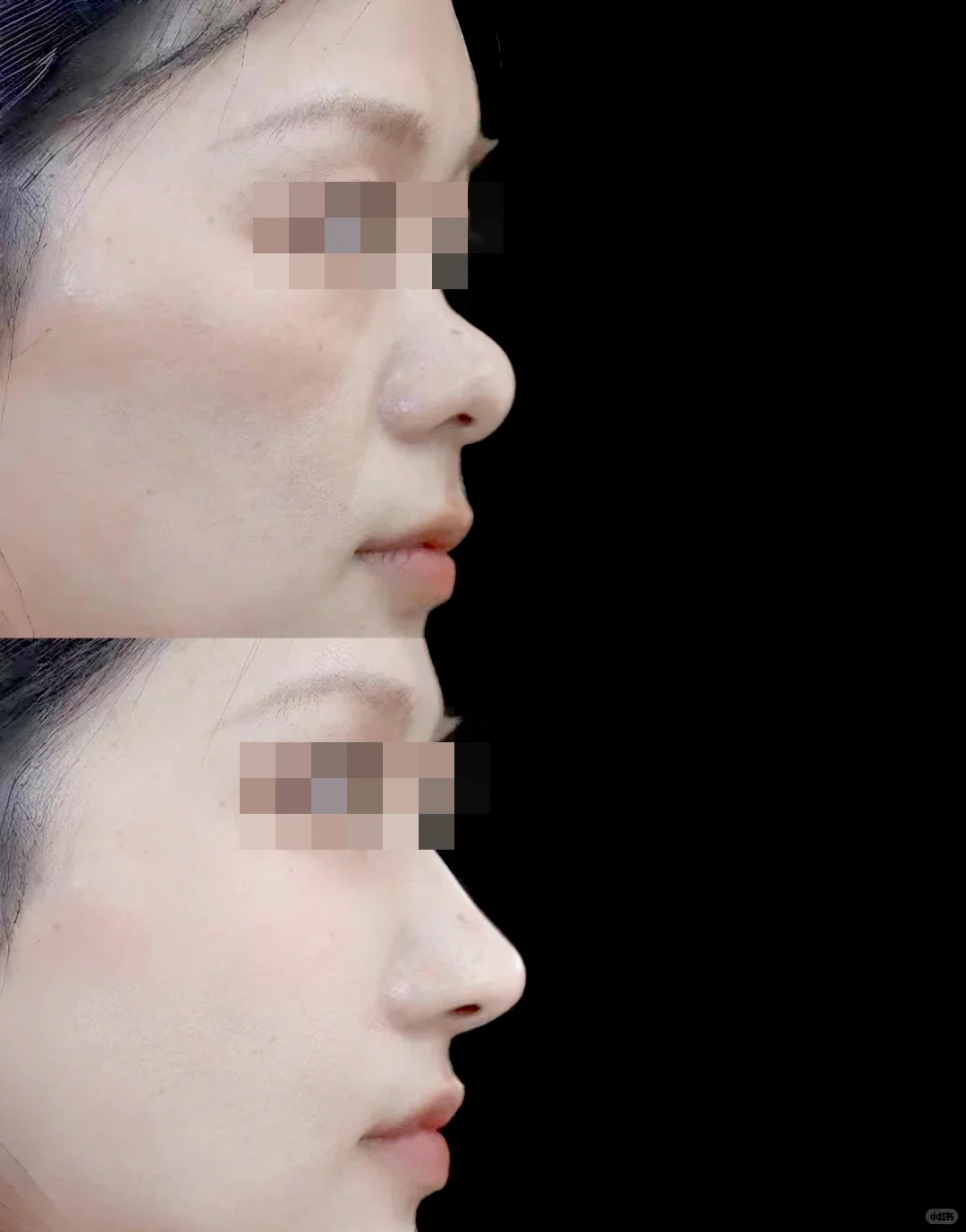 重塑鼻型美感，山根高度增加 2.3mm