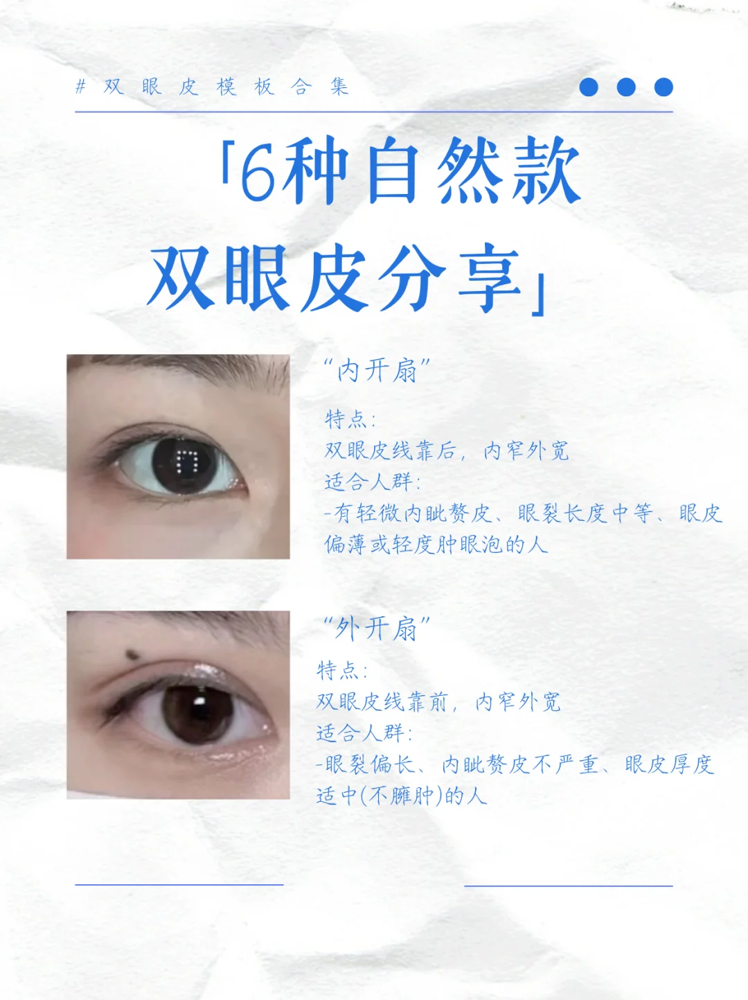 三种常见双眼皮款式细分！