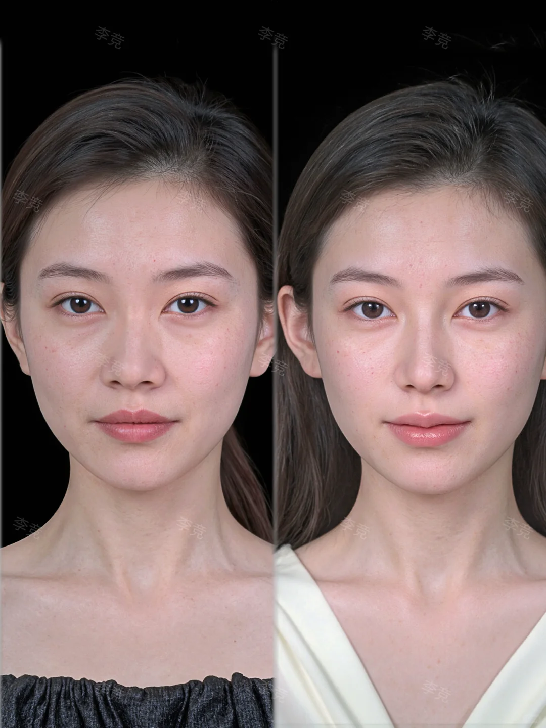 成都隆鼻|4mm抬高鼻背，微起伏精致骨感