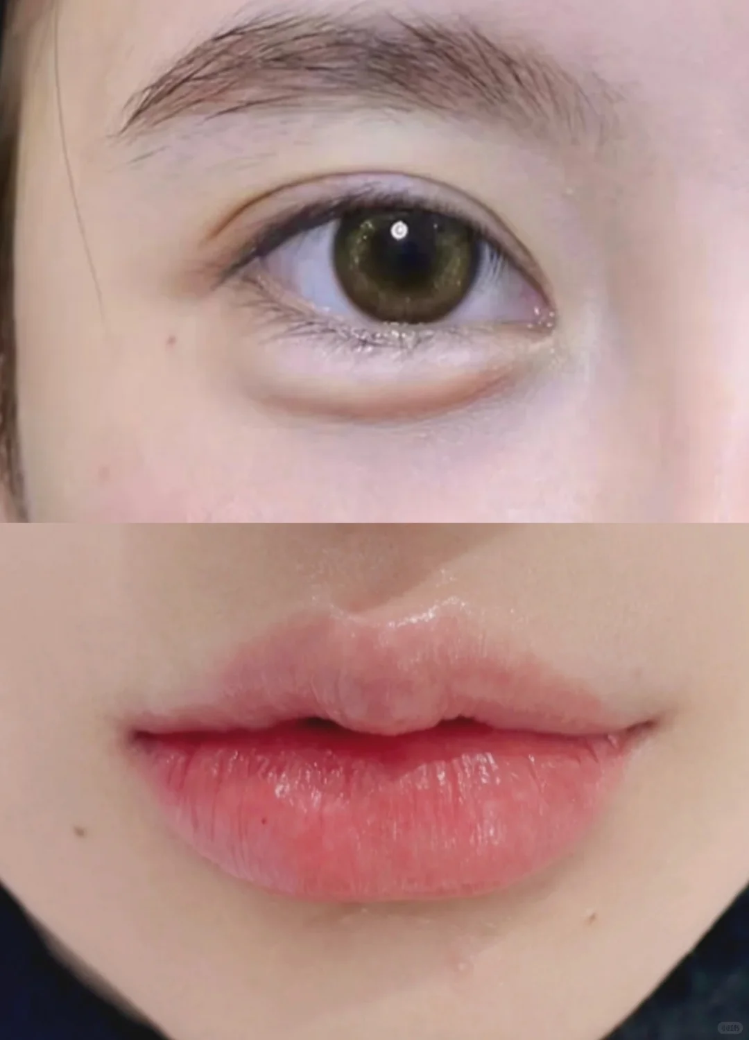 只用了1ml的卧蚕➕️丰唇