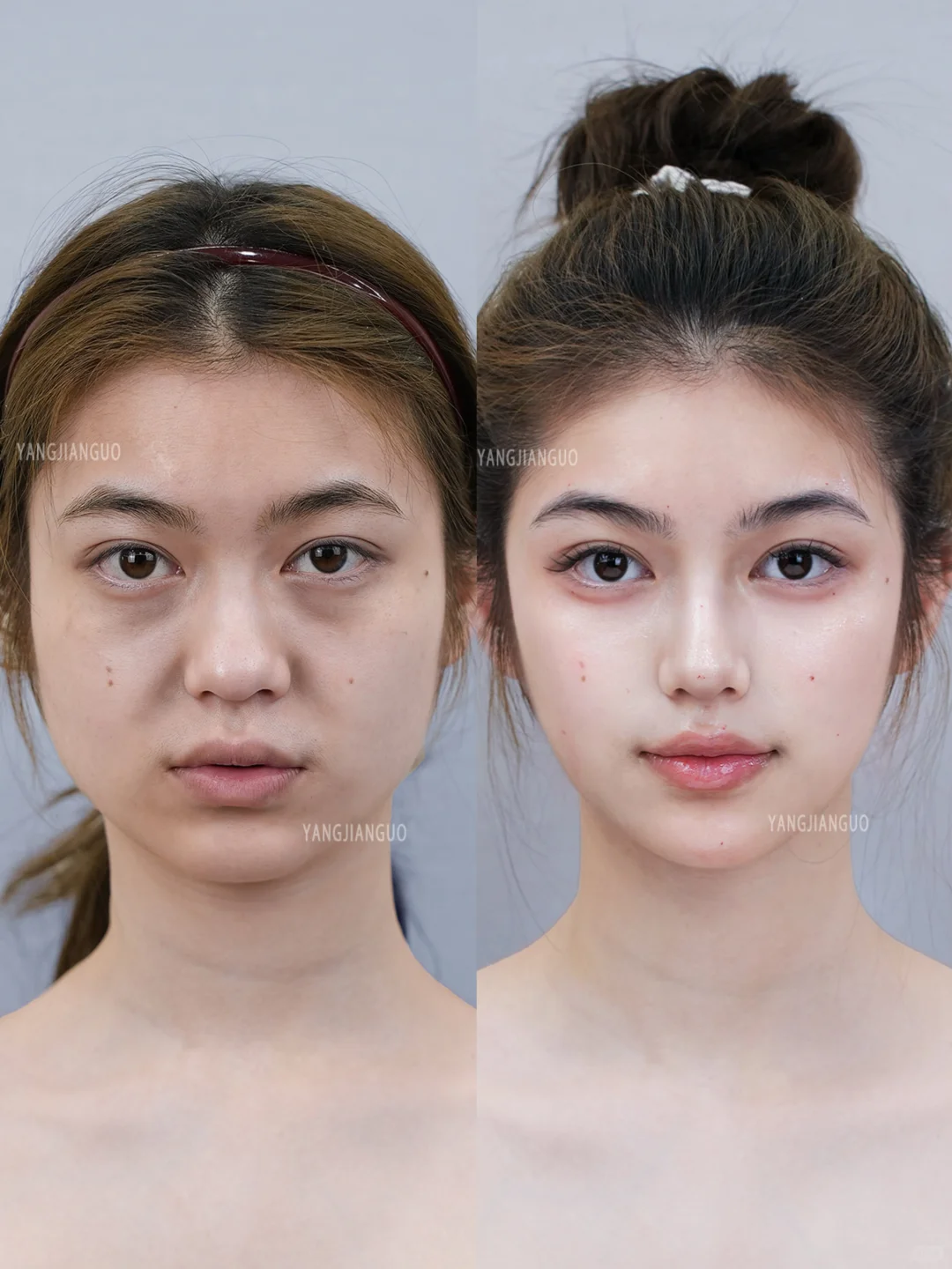 2支濡白鼻+鼻基底+下巴，微调完像换了一张脸