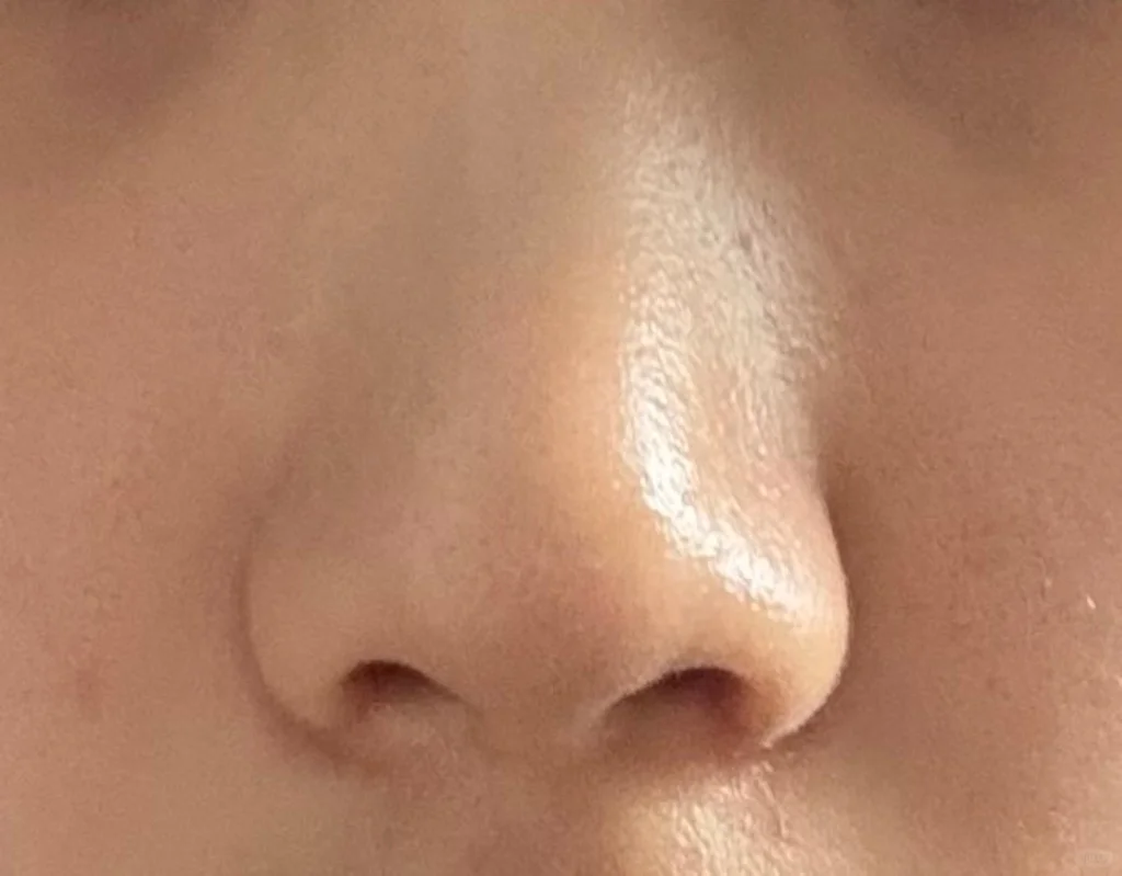 做了鼻翼鼻头缝合没放东西