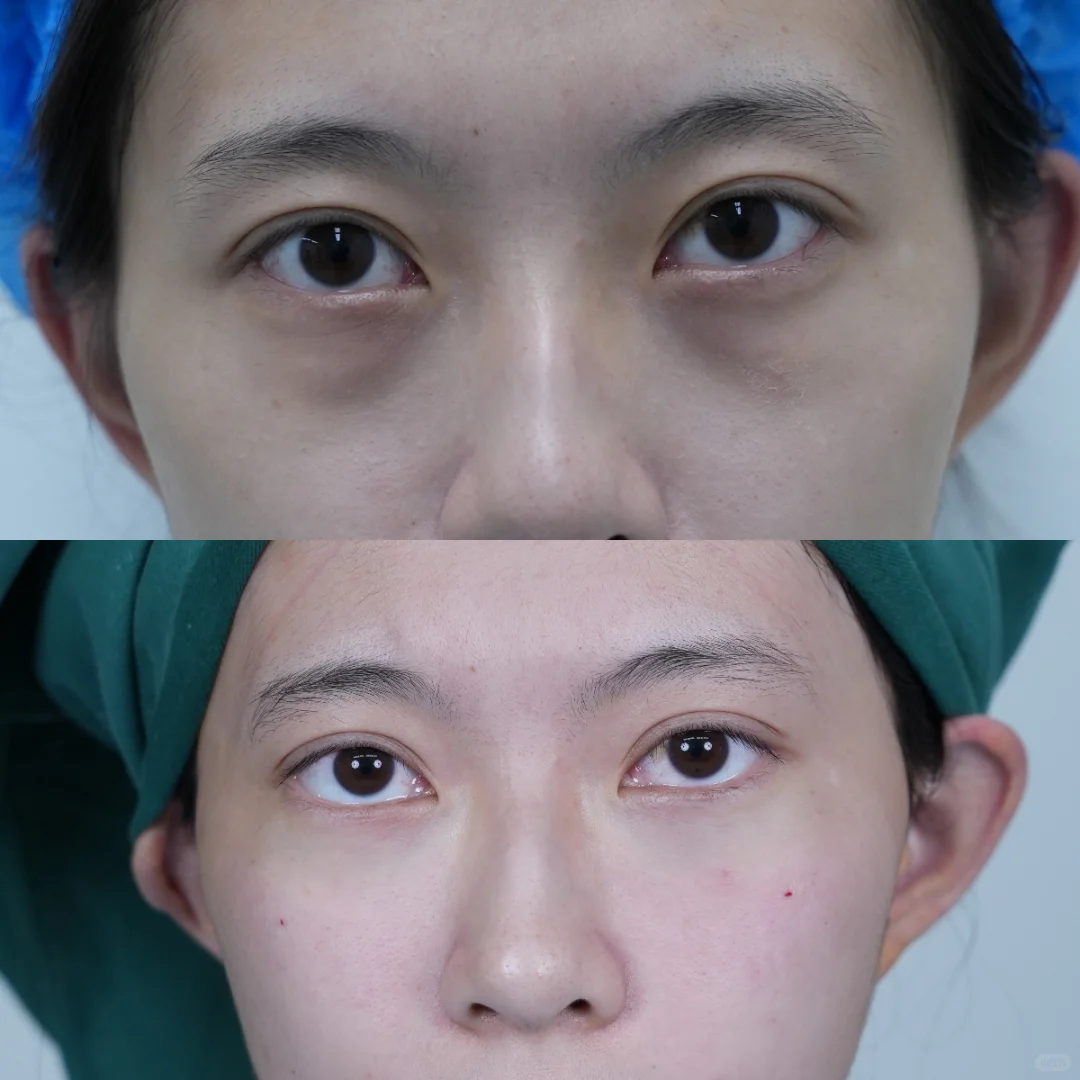 嘎完眼袋后就像变了一个人