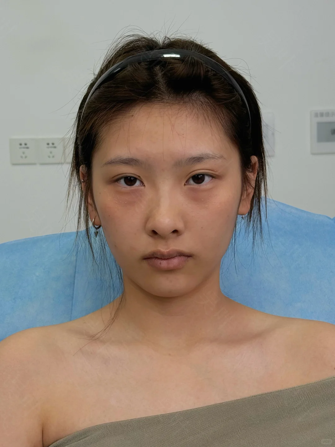 成都黑眼圈泪沟填充，live直出