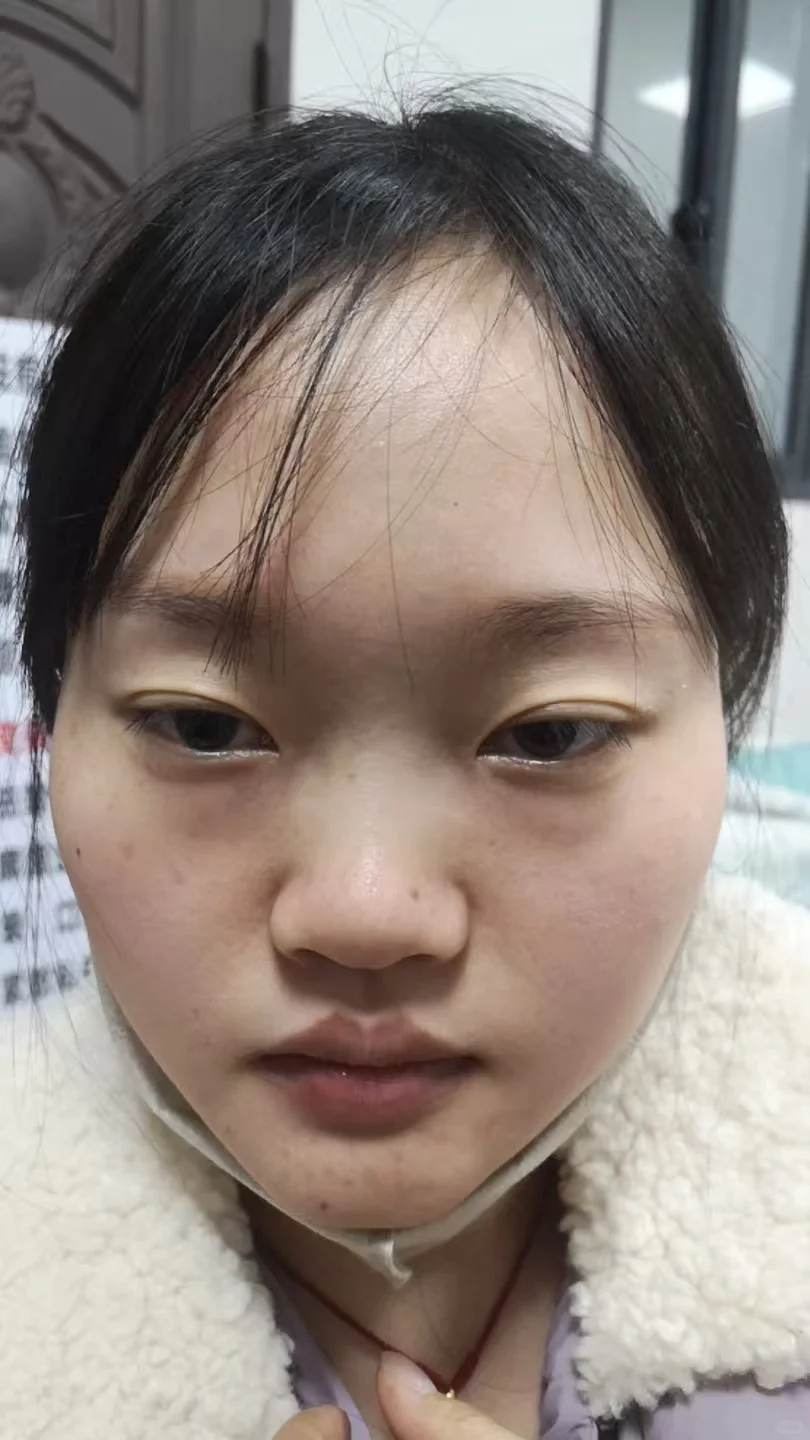 打鼻子👃第4天 我这算还行吧 无痛长个鼻子